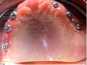 Con implantes