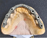Prótesis híbrida sobre implantes - protocolo