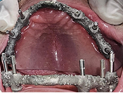 Prótesis híbrida sobre implantes - protocolo