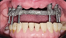 Prótesis híbrida sobre implantes - protocolo