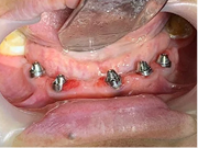 Con implantes