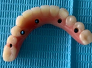 Prótesis sobre implantes - protocolo