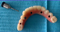 Prótesis sobre implantes - protocolo