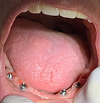 Con implantes