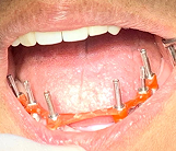 Prótesis híbrida sobre implantes - protocolo
