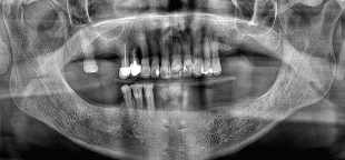 Radiografía