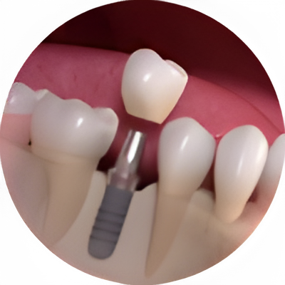 Implantes Dentales