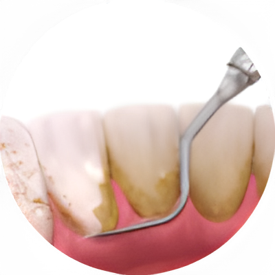 Prevención (Profilaxis y Destartraje)